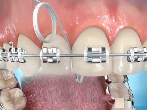Superfloss fogselyem fogszabályozó készülék tisztítása